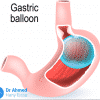 بالون المعدة في مصر