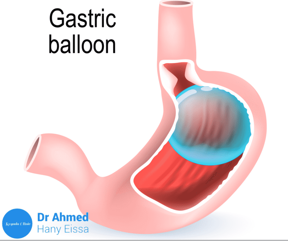 بالون المعدة في مصر