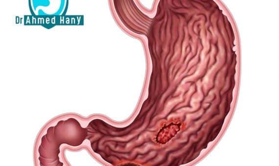 قرحة المعدة