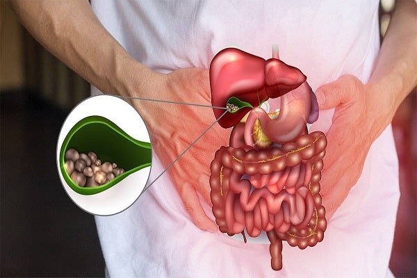 عملية تفتيت حصى المرارة بالمنظار